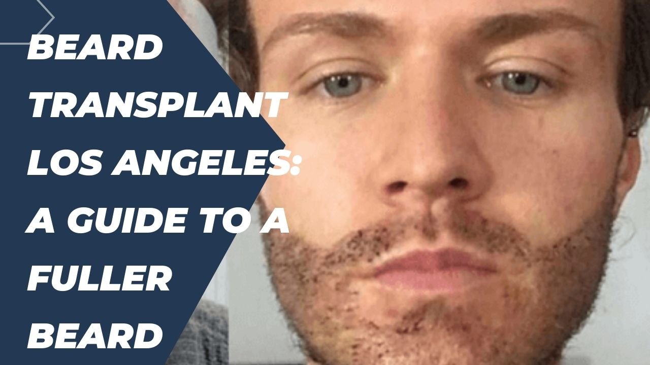 Beard Transplant Los Angeles: A Guide to a Fuller Beard